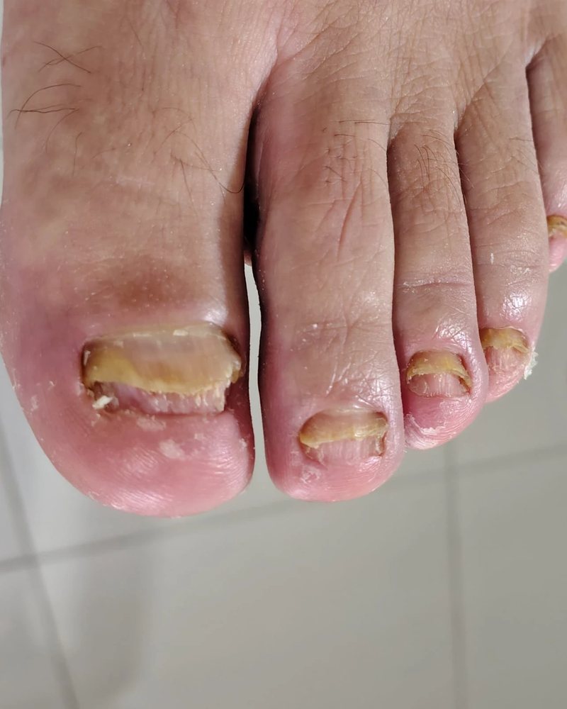Antes: unhas amareladas, grossas e descolando por causa da micose