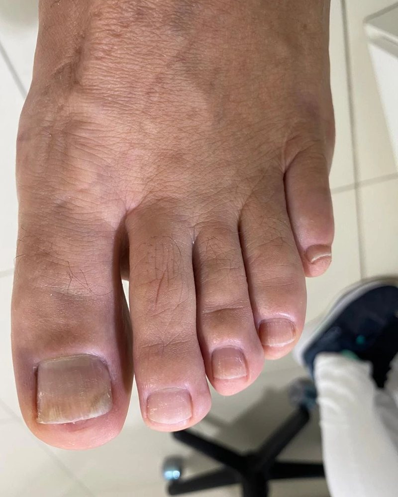 Depois: unhas limpas, finas e com a cor normal