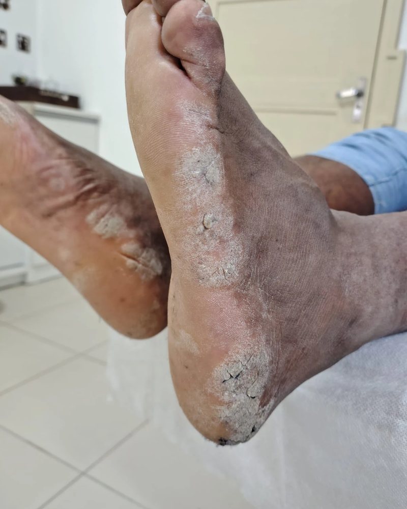 Antes: pés com placas grossas e descamação causadas pela psoríase